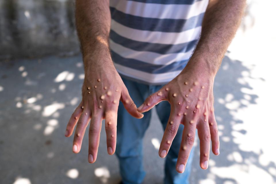 The main symptom of monkeypox is a rash that starts out as small spots and progresses into pus-filled blisters