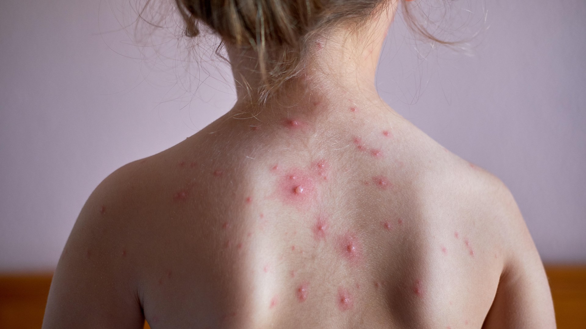 Risk of mpox being 'confused with chickenpox' after new killer strain detected in the UK - how to spot the difference