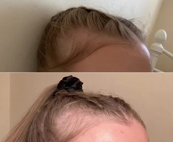 One stunner took to TikTok to rave over rosemary oil, which gave a major boost to her hairline