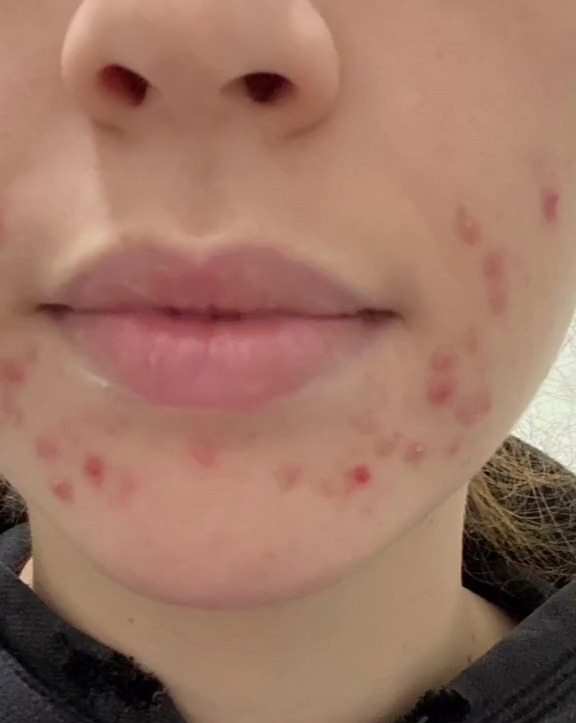 She struggled with acne for years before finding the skincare range