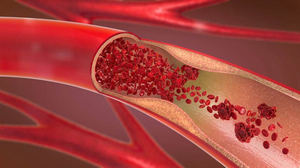 Peripheral artery disease is where a build-up of fatty deposits in the arteries restricts blood supply to leg muscles