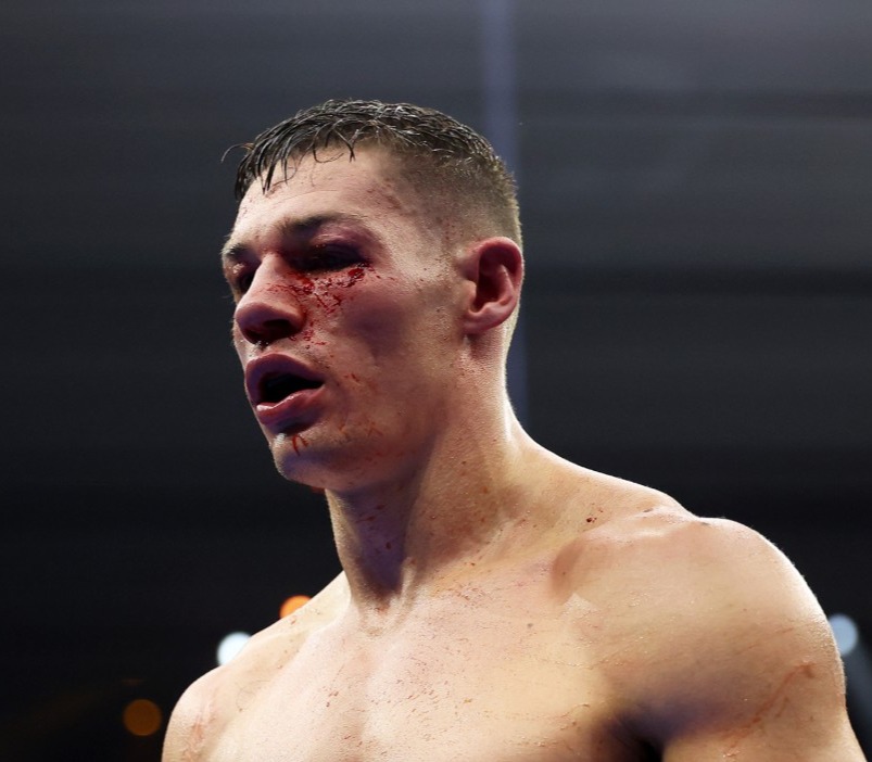 Billam-Smith suffered a nasty eye injury during the title fight