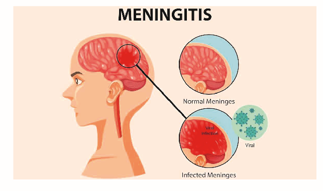 Meningitis Killed 361 In 1 Year – NCDC