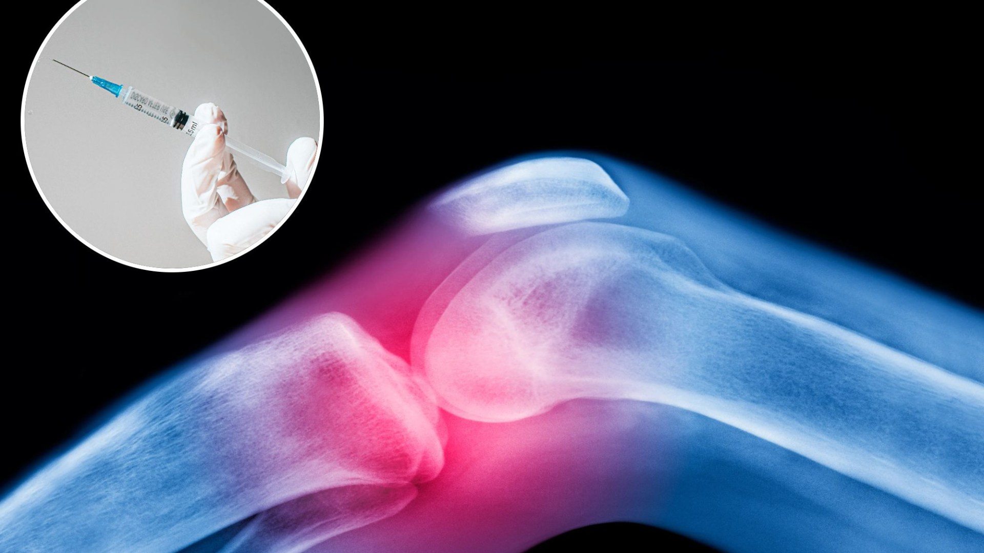 New injection 'could prevent knee replacement surgery for millions and relieve agonising pain'