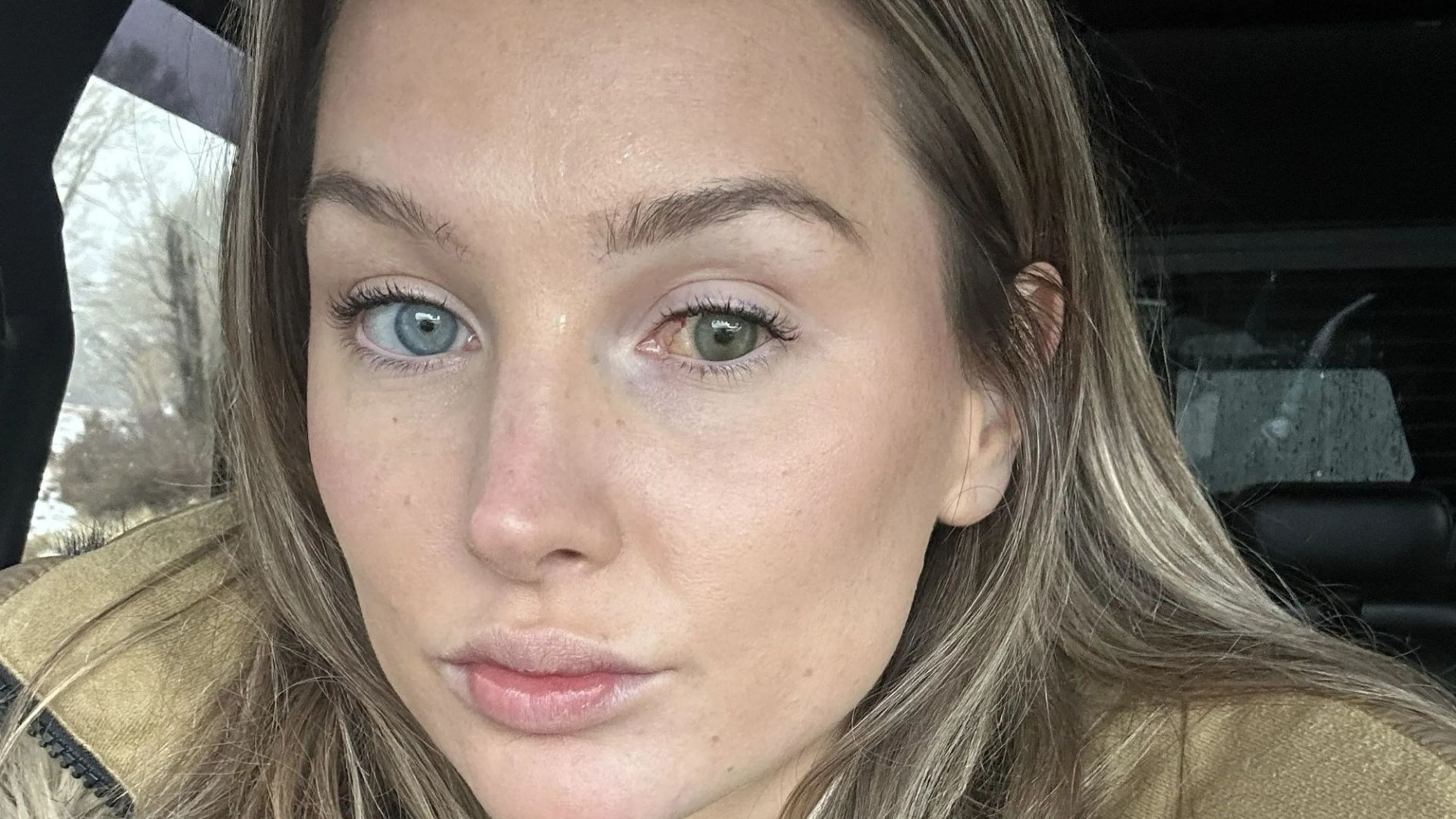 Vogue model, 24, left permanently blind in one eye after pal 'whacked her in the face with a Dior bag on a night out'