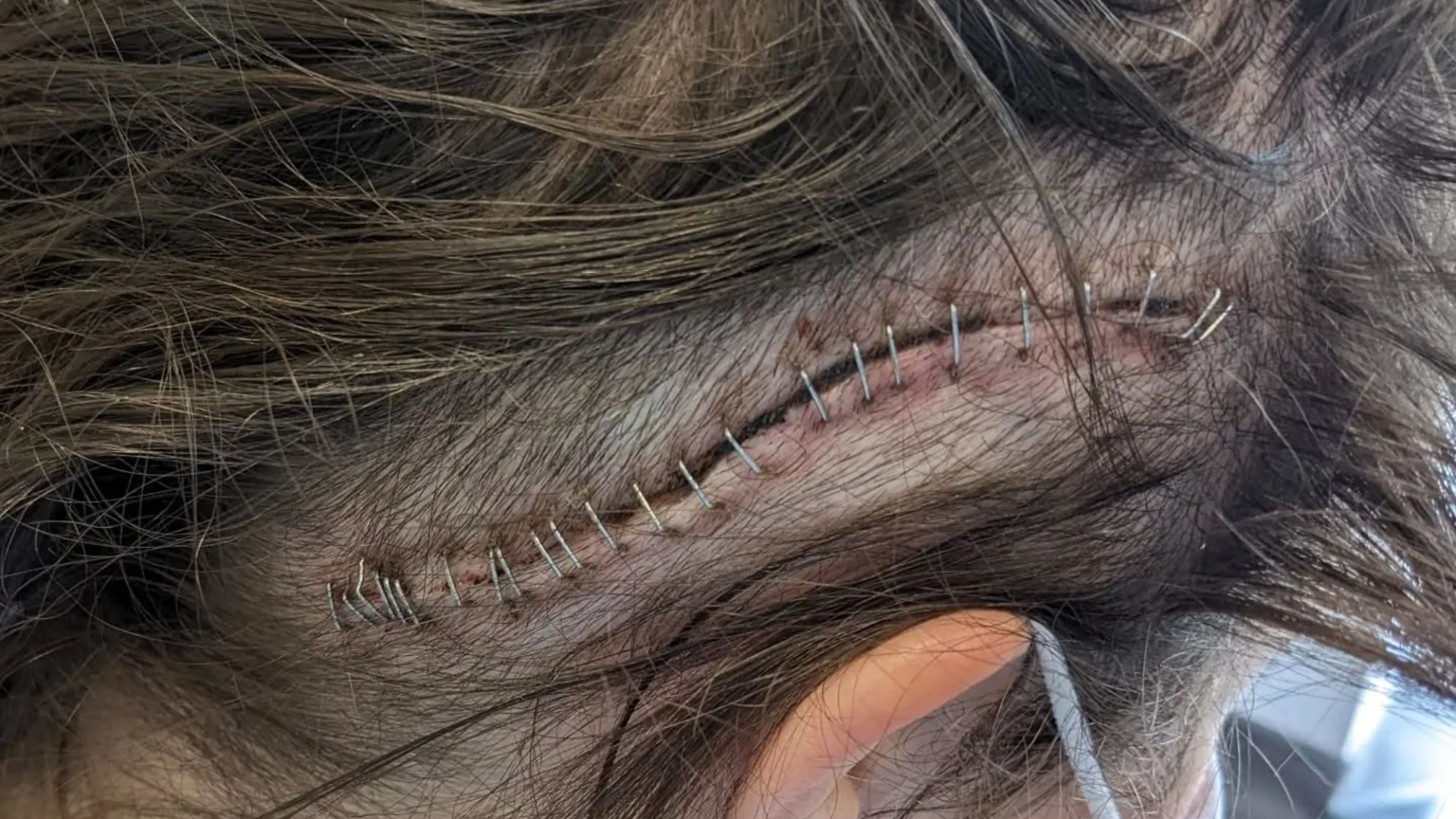 Antiques Roadshow's Theo Burrell shares 'gruesome' photo of head scar as she 'anxiously waits' for latest test results