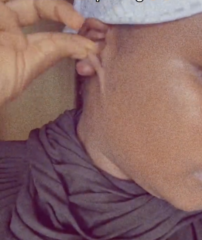 Lady lands in hospital after piercing extra earring hole, battles keloid