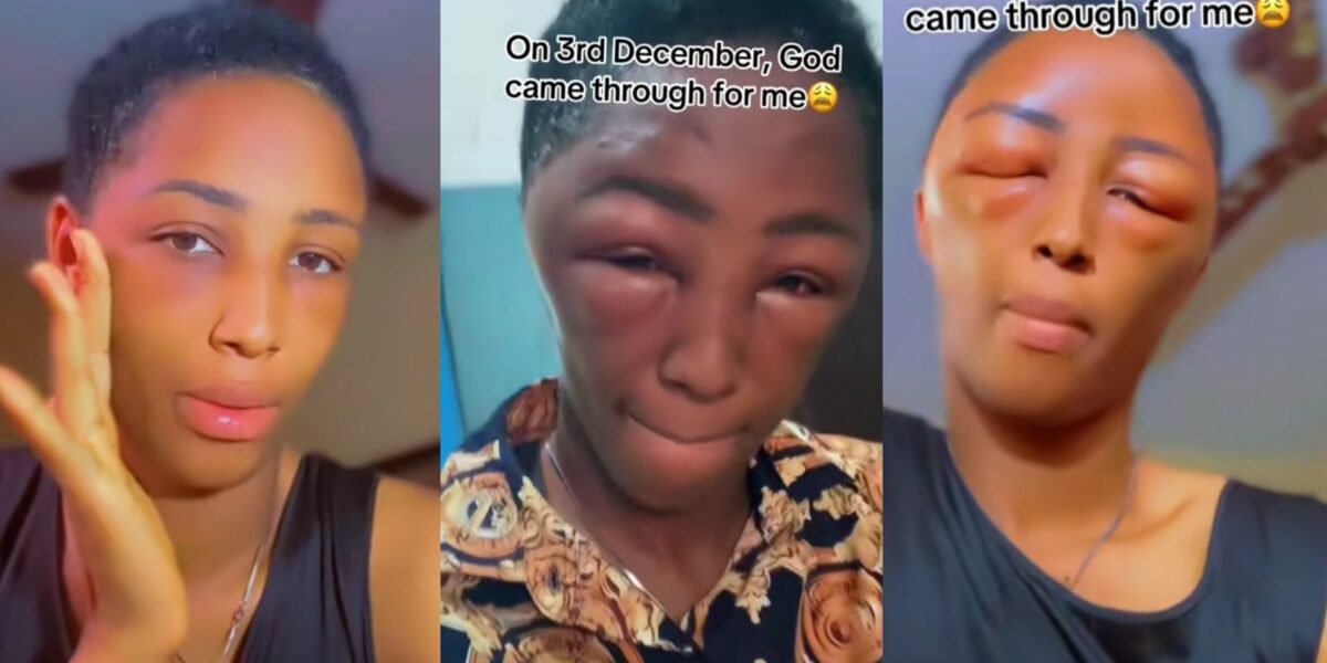 Lady suffers allergic reaction after applying dye on hair