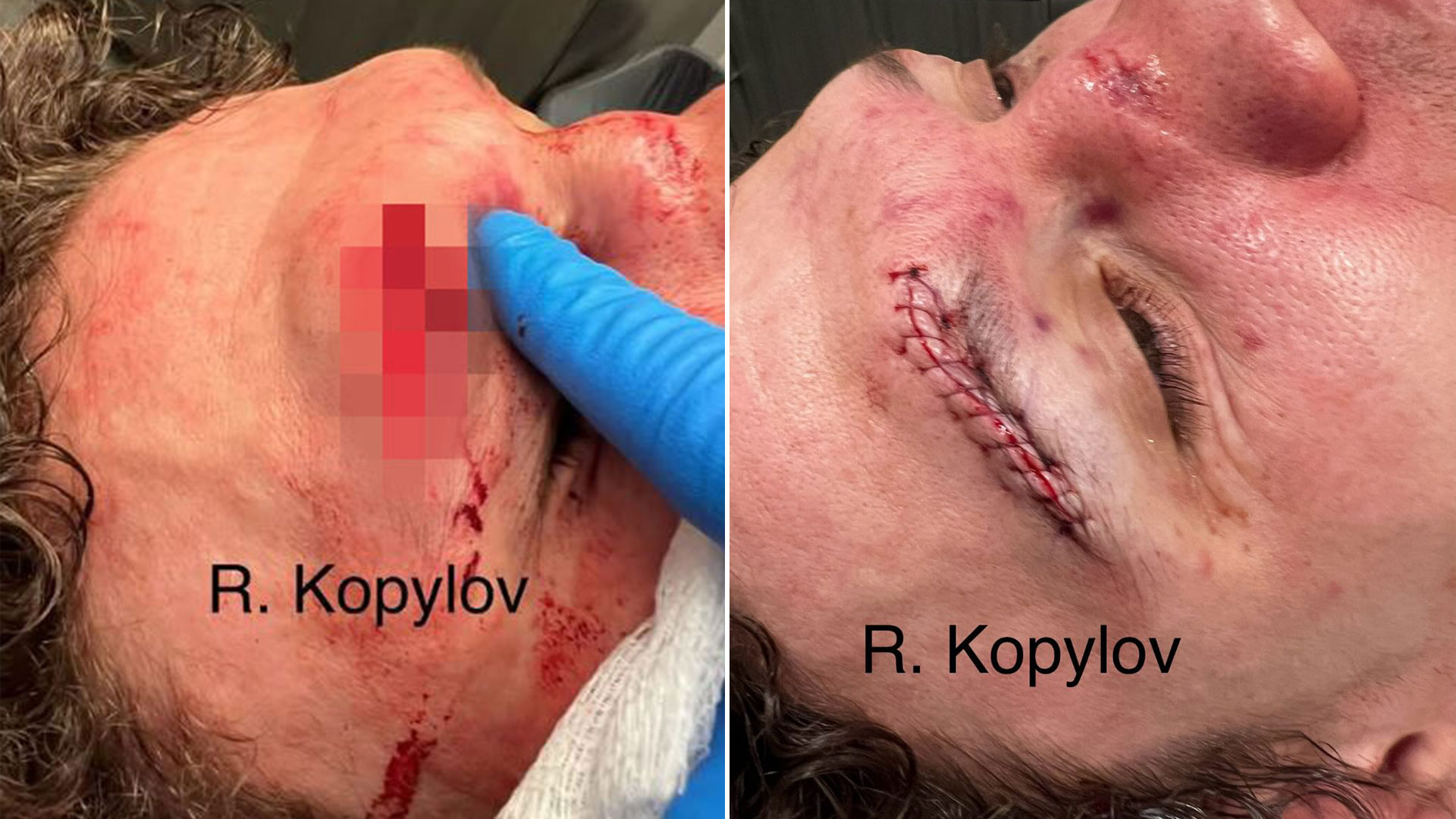 UFC star suffers sickening gash on his head and left needing stitches as Dana White shares gruesome snap